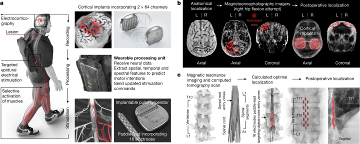 Diagram showing the process of the Brain-Spine Interface (BSI) implantation. Part A illustrates two cortical implants with 64 electrodes each, positioned over the sensorimotor cortex, connected to a processing unit and an implantable pulse generator. Part B shows pre-operative planning and postoperative confirmation of cortical implant locations. Part C presents a personalized computational model predicting the optimal placement of the paddle lead for lower limb muscle targeting, along with postoperative confirmation.