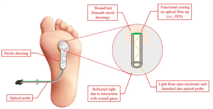 Smart wound dressing with optical fiber sensors for remote monitoring of wound factors, enabling timely dressing changes and alerting clinicians to infected or slow-healing wounds. Enhances patient care and reduces healthcare appointments.